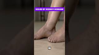 Signs of Kidney Disease [upl. by Garlinda]