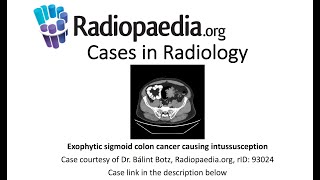 Exophytic sigmoid colon cancer causing intussusception Radiopaediaorg Cases in Radiology [upl. by Anerdna]