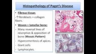 Bone DiseasesFibroosseous amp Developmental lesionsOral Pathologywmv [upl. by Atirys]