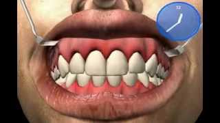 Why gums bleed  what is Gingivitis [upl. by Jeane]