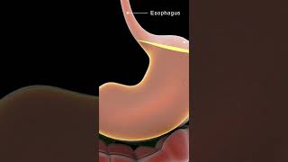 Understanding Achalasia Cardia  Causes amp Solutions [upl. by Ong]