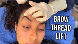 2020s Hottest Cosmetic Trend Thread Lifts Brow Lift with Threads [upl. by Rupert]