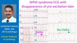 WPW syndrome ECG with disappearance of preexcitation later [upl. by Nayd696]