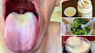 10 Remedios Caseros Para Tratar La Candidiasis Oral [upl. by Erusaert]