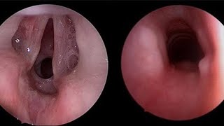 Pediatric Congenital Subglottic Stenosis [upl. by Betsy]