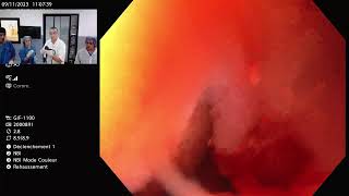 Esophageal stricture [upl. by Blunk629]