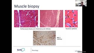 Dermatomyositis clinical case and treatment [upl. by Nedroj]