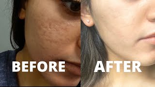 MY CO2 LASER RESURFACING TREATMENT EXPERIENCE  how to get rid of acne scars amp hyperpigmentation [upl. by Solita]