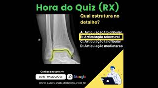 Radiografia do tornozelo Articulação Talocrural [upl. by Arytal560]