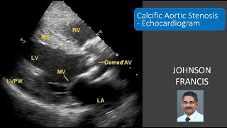 Calcific Aortic Stenosis  Echocardiogram [upl. by Assilen370]