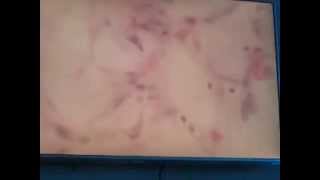 Lipoma y Liposarcoma Práctica de patología [upl. by Eibrad284]