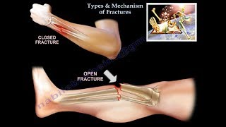 Types amp Mechanism Of Fractures  Everything You Need To Know  Dr Nabil Ebraheim [upl. by Roskes]