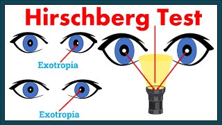 Hirschberg Corneal Reflex Test  A complete Tutorial [upl. by Haim]