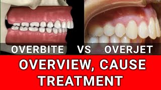 Overbite VS Overjet  Condition Overview Cause and Treatment [upl. by Ihsorih]