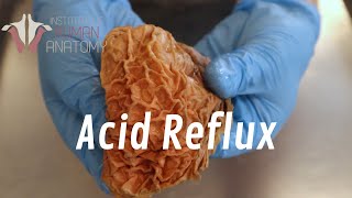 What Is Acid Reflux [upl. by Yborian447]