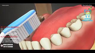 BAD BREATH OR HALITOSIS PERIODONTICS [upl. by Anegue]