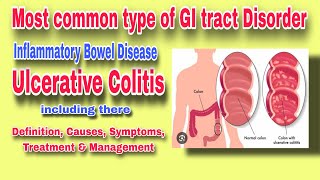 Ulcerative Colitis  Inflammatory bowel disease  Large intestine Disorder [upl. by Enelhtak]