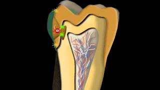 Dental Caries Treatment [upl. by Pontius382]