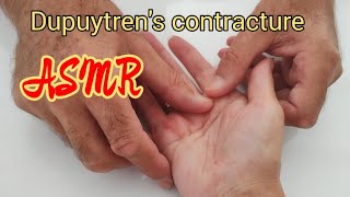 ASMR Hand massageDupuytrens contractyre asmrtherapy [upl. by Chapman]