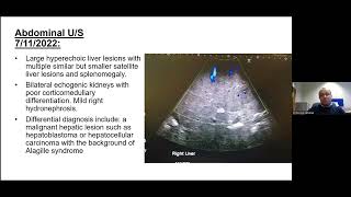 Alagille syndrome and genetic diagnosis of cholestasis in infants  Dr E Elkhatiali [upl. by Kcirdef462]