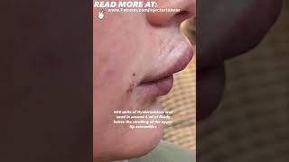 Join my Patreon at wwwpatreoncominjectortanner hyaluronıdase dissolvingfiller dissolvinglips [upl. by Deys]