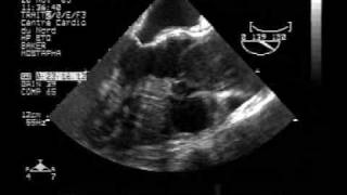 echocardiogramTEE dissection of the ascending aortatype A [upl. by Monafo249]