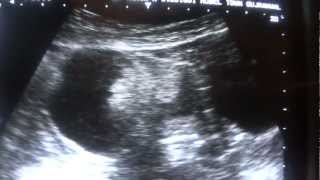 DERMOID CYST ultrasound [upl. by Maier22]