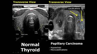 Thyroid Ultrasound Normal Vs Abnormal Image Appearances Comparison  Thyroid Pathologies USG [upl. by Aerdnahc]