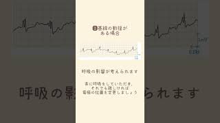 1分以内でわかる👀心電図検査 ーアーチファクト編ー [upl. by Rooke]