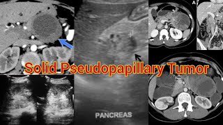 Radiology Viva Case  04  Solid Pseudopapillary Tumors of the Pancreas medical radiology doppler [upl. by Rhett]