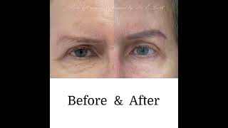 How to Safely amp Effectively Use Botox for Brow Lift [upl. by Karlyn]