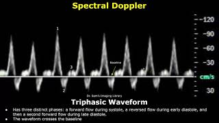 Monophasic Biphasic amp Triphasic Spectral Doppler Waveforms  Vascular Ultrasound Analysis USG [upl. by Patton]