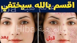 اقسم لكم بالله 10 وصفات متوفرة في كل بيت تخلصك من حب شباب واثاره خلال يوم واحد فقط [upl. by Ellinej231]