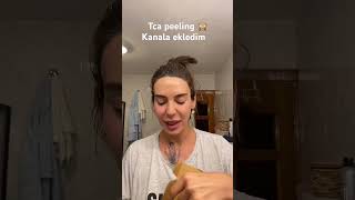 Tca peeling yaptım 🙈 uzun hali kanalda [upl. by Airotnes]