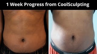 1 Week Progress from CoolSculpting  Fat loss coolsculpting [upl. by Amos]