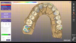 Exocad Exoplan 3Shape InLab Cerec [upl. by Eetak]