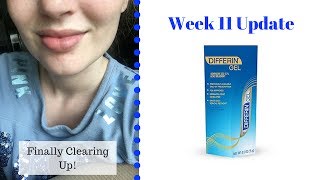 Differin Gel Retinoid Treatment  Week 11 Update [upl. by Gainor847]