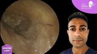 1260  Very Complex amp Challenging Ear Cleaning Video [upl. by Nyrok]