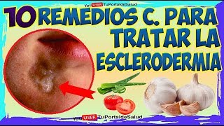 10 Remedios Caseros para Tratar la Esclerodermia [upl. by Elazaro]