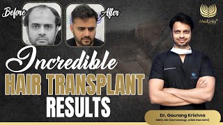 Incredible Hair Transplant Results  Medlinks [upl. by Nauqyt394]