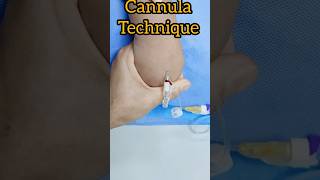 How to insert cannula  cannula passing technique trending shorts viralshorts [upl. by Enomar840]