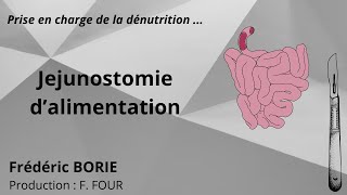 Pose de jéjunostomie dalimentation [upl. by Ajad]