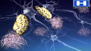 Alzheimers disease Pathophysiology Symptoms Causes and Treatment  3D animation [upl. by Anoi]