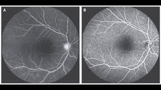 Vaskulitis der Retina bei Takayasu Arteriitis [upl. by Llerreg]