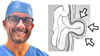 Umbilical hernias  What are they and when do we treat them [upl. by Yumuk637]