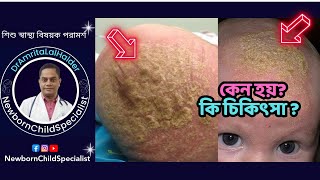 ক্যাডল ক্যাপের চিকিৎসা। cradle cap removal in bangla ডাঅমৃত লাল হালদারনবজাতক ও শিশু বিশেষজ্ঞ। [upl. by Dlareme]