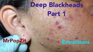 Deep waxy pore plugs removed 20 minutes of extractions with MrPopZit [upl. by Maure]