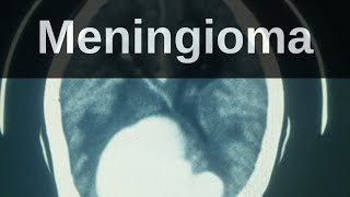 What is a Meningioma Pathology mini tutorial [upl. by Amla125]