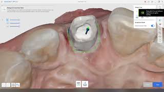 Designing a temporary crown with a screw channel on Medit ClinicCAD [upl. by Evanne53]