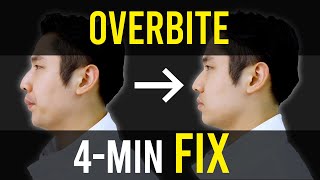 Overbite amp Overjet Fix｜Facial Asymmetry Correction｜Corrective Exercises [upl. by Erny704]